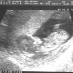 12 week ultrasound