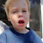 Fat lip from falling off his bike